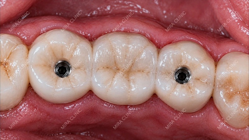 Screw-access areas